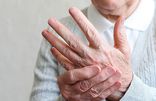 Arthritis (Rheumatoid Factor) Home Test Kit UK